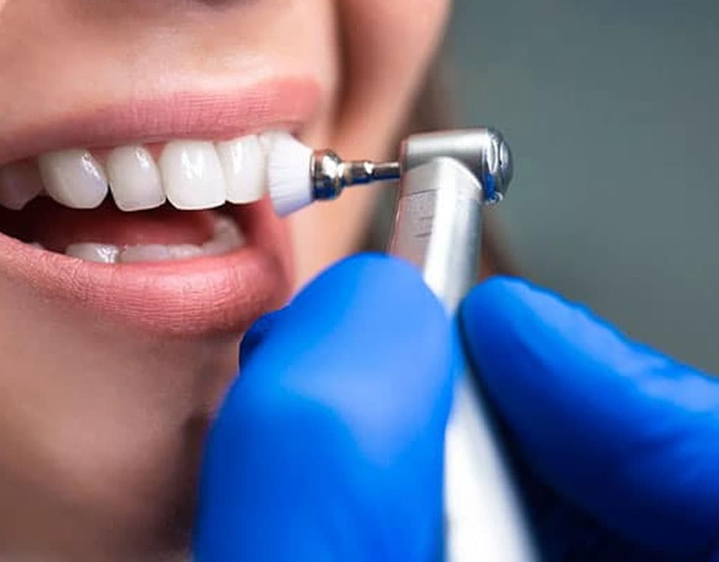 limpieza dental tavernes